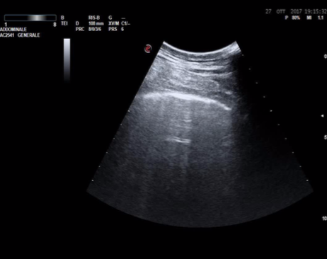 Ecografía pulmonar en paciente con SARS-COV-2